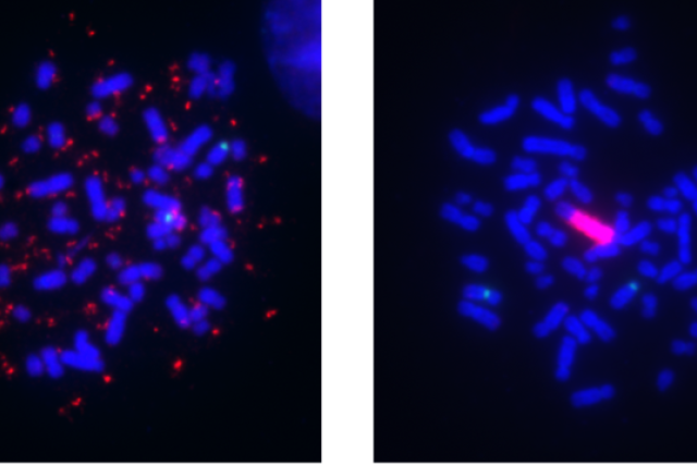 Melanoma cell lines showing gene amplification.Melanoma cell lines can harbor BRAF gene amplification (red signal) in two remarkably different modes, as extrachromosomal DNA (ecDNA) (left) and as an intrachromosomal homogeneously staining region (HSR) (right).