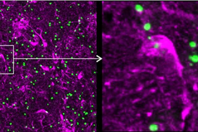 Huntington's disease graphic