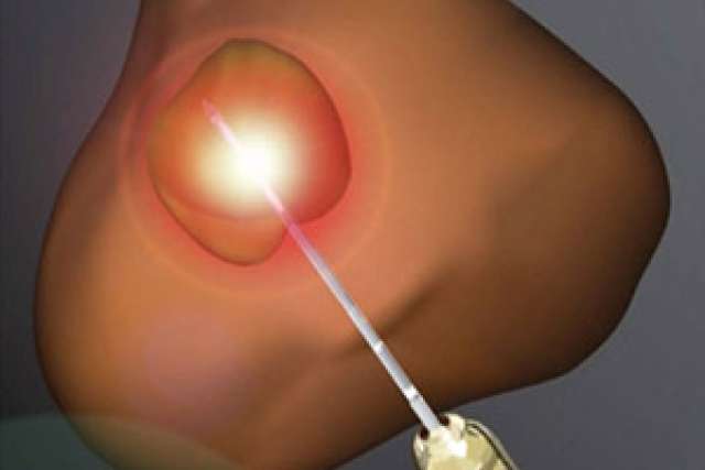 Laser ablation becomes viable treatment for cancer Health
