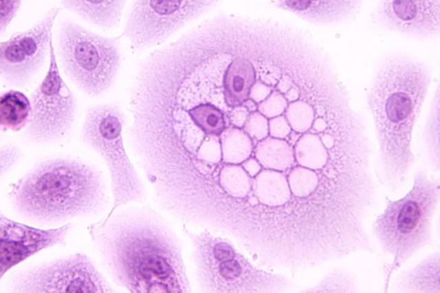 microscopic view of HPV oncoprotein, displaying purple cells 