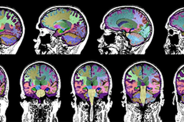 Brain scans for dementia study