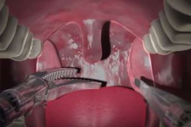 Robotic miniature arms entering mouth