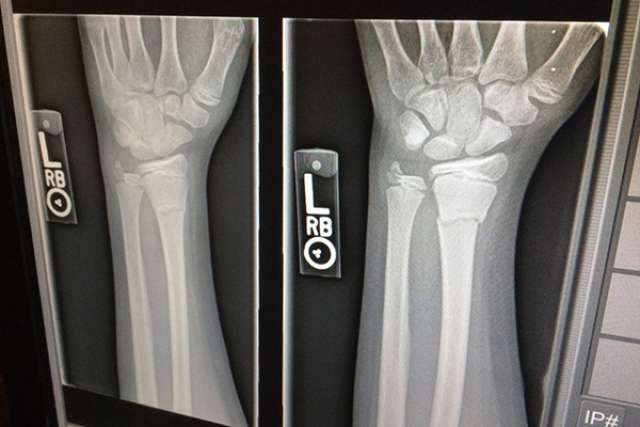 Wrist X-ray