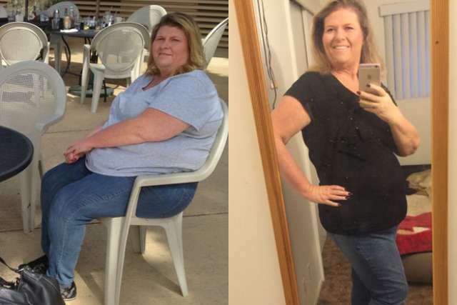 Judy's Story - Before and After Gastric Bypass Surgery