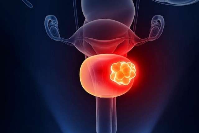 There are many levels of prostate/genitourinary cancers, and our UCLA team assures treatment is customized for each patient.