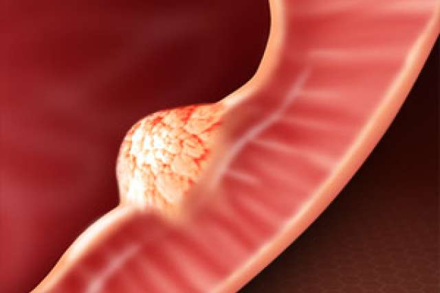 Video Library Cancer