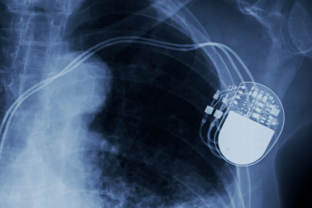  An X-ray shows a pacemaker implanted in the upper left chest of a human, with wires extending down into the heart region.