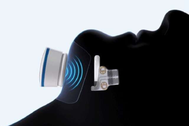 The newest sleep apnea device implanted in the body.