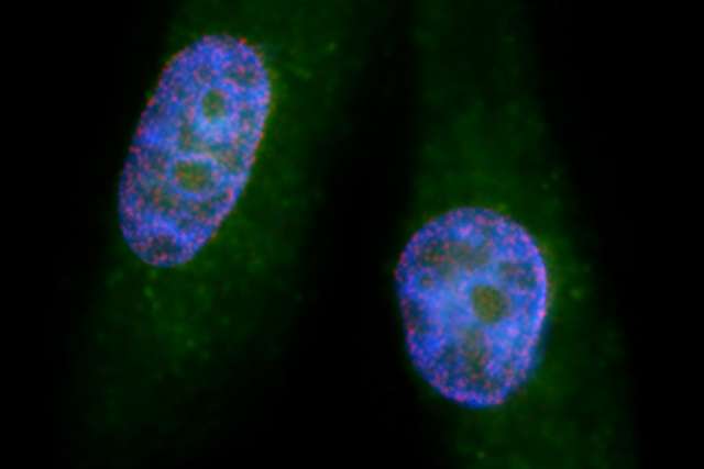 cancer cells-pancreatic