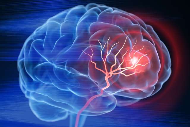 A 3D illustration shows an X-ray view of a brain stroke.