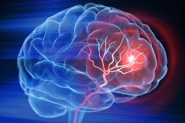 3D holographic brain with tumor