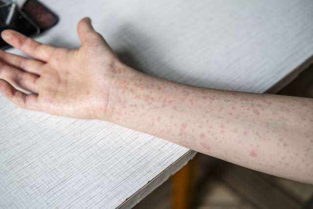 Measles rash on boy's arm