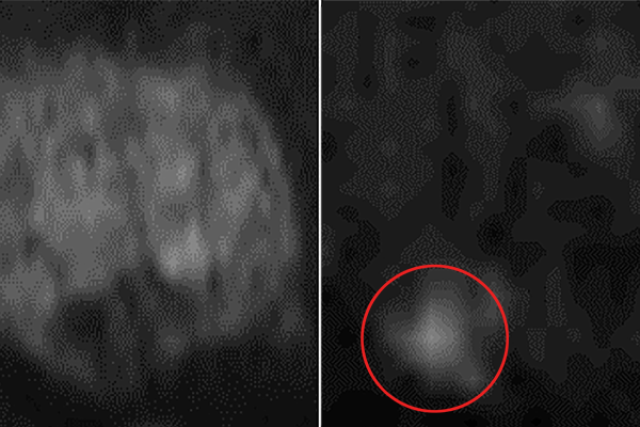 Scan comparison of MRI images with invisible and visible tumors