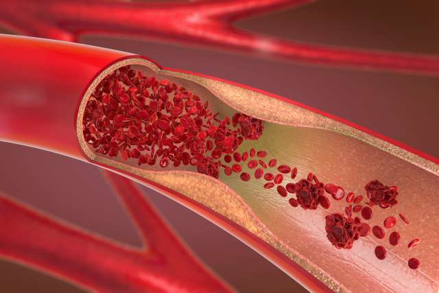  constricted and narrowed artery and the blood cannot flow properly called arteriosclerosis