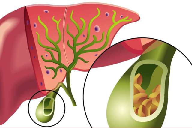 Illustration of a liver with green bile ducts and a close-up of the gallbladder showing gallstones inside.