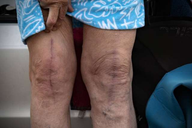 Close up of Robert Lombard's knees displaying the scars from the surgery