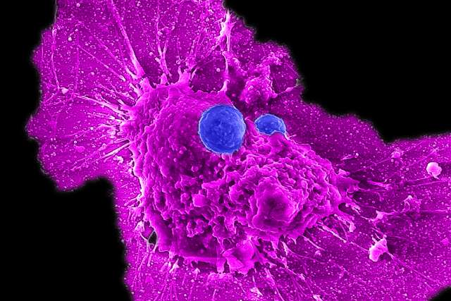 Lili Yang Lab/UCLA Microscopy image showing allogeneic stem cell-derived CAR-NKT cells (blue) attacking a human ovarian cancer cell (magenta)