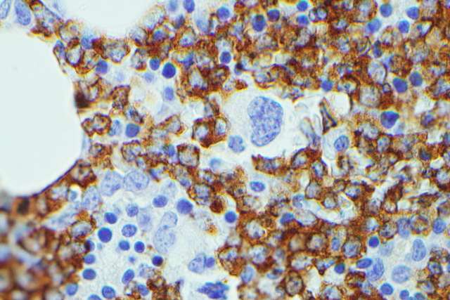 IGF2BP3 IHC performed on a B-ALL case; the blasts are positive and the normal hematopoietic cells are negative.