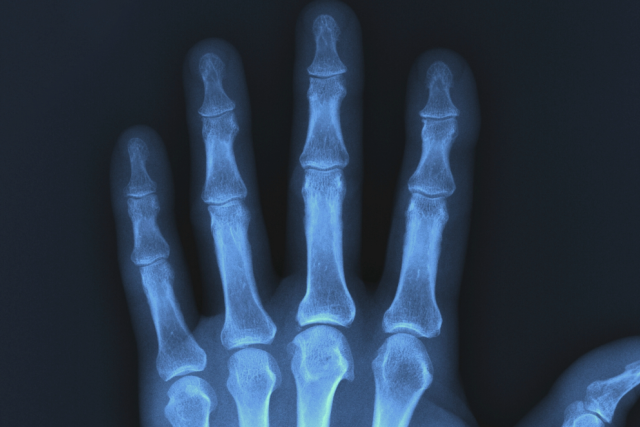 X-Ray of a left hand.