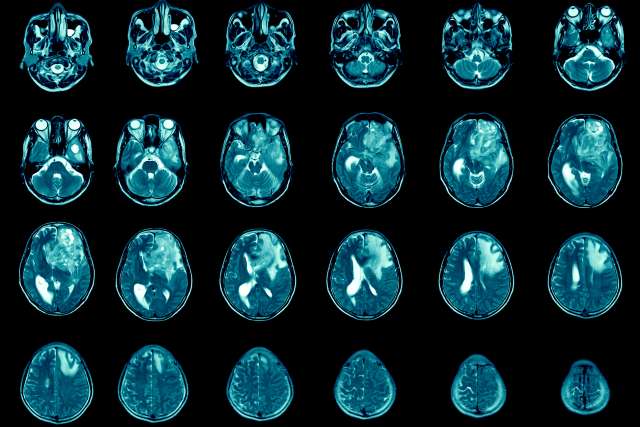 Magnetic resonance imaging Finding 5 cm isodense mass with ill-defined margin and surrounding edema at Left frontal lobe.