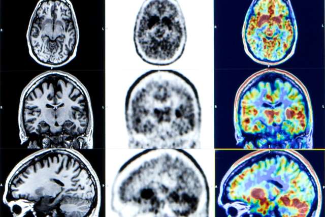 grid of brain scans