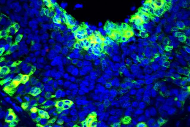 Metastasized lymph node