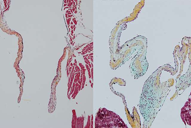 Heart valve comparison