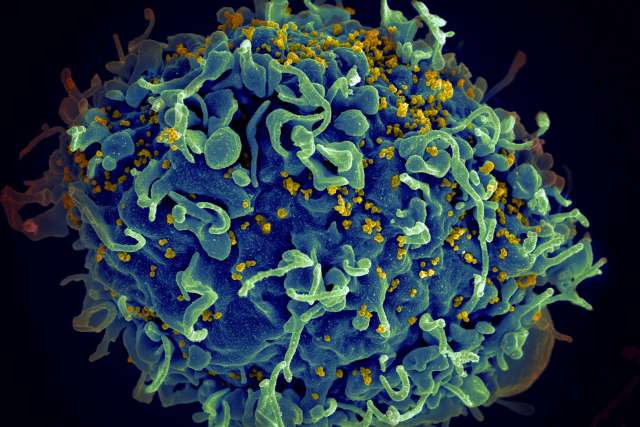 Microscopic image of a human T cell, in blue, under attack by HIV, in yellow.