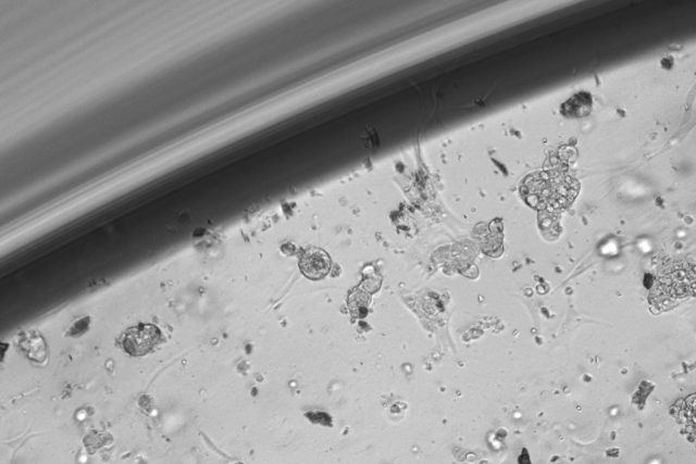 Chordomas are tumors that arise in the sacrum or skull base. Their primary treatment is surgery, but because of their location, complete removal is not always feasible.