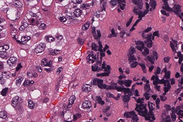 Non small cell and small cell cancers