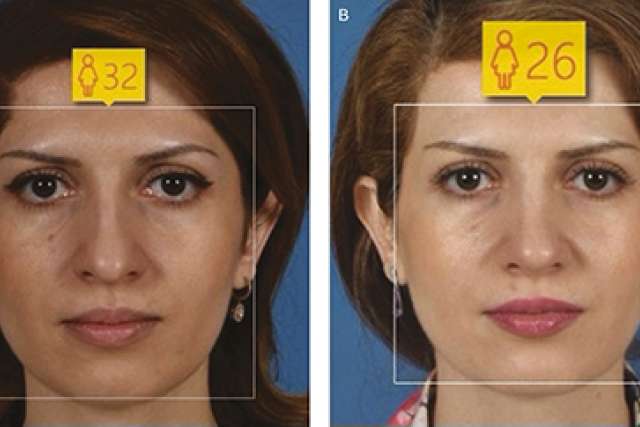 Before and after rhinoplasty-age 32