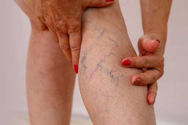 An elderly woman touching her legs and varicose veins.