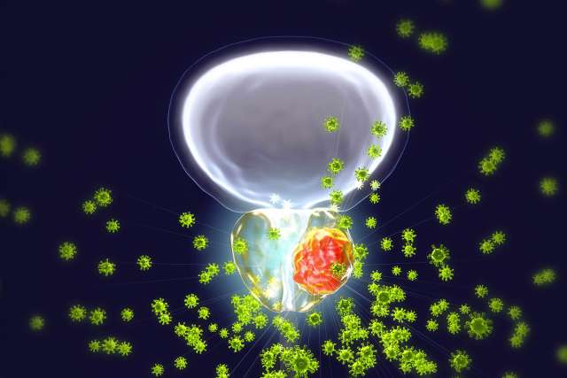 Microscopic view of prostate cancer cells
