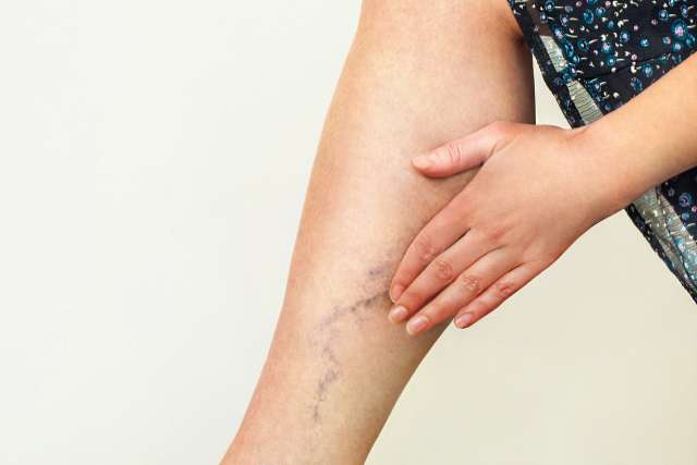 Varicose veins on the womans legs