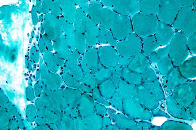 A close up image of a pathology slide, stained aqua.