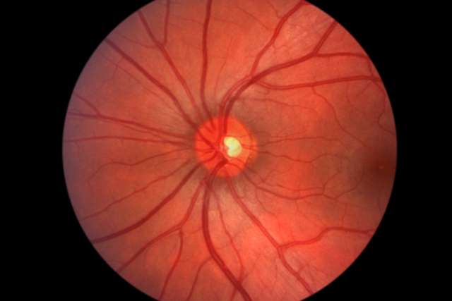 Retina - Optic Nerve - Human Eye