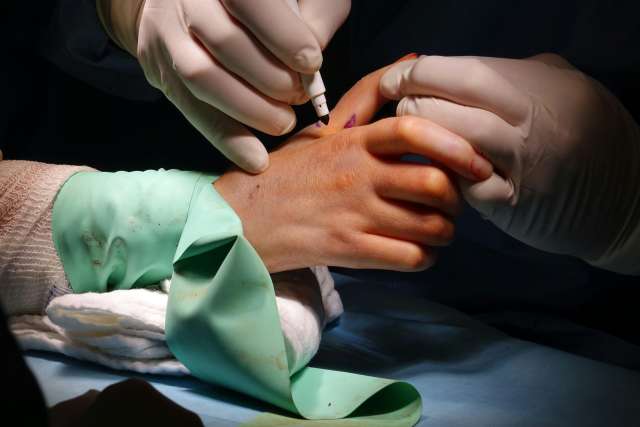 Close up of surgery on hand at the amputation clinic