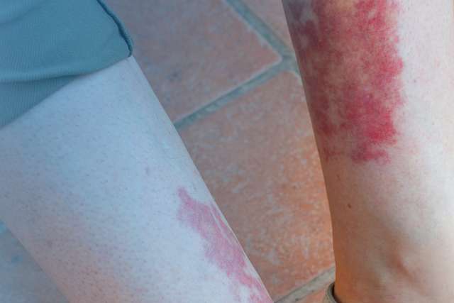 Leukocytoclastic vasculitis, an inflammatory reaction in the blood vessels appearing on woman's leg