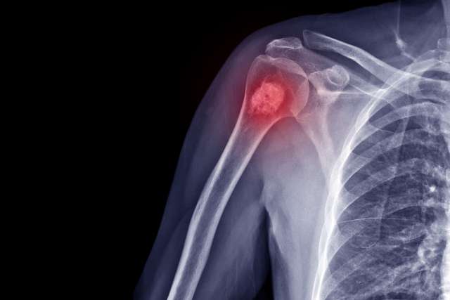 X-ray of shoulder radiograph showing Enchondroma disease.