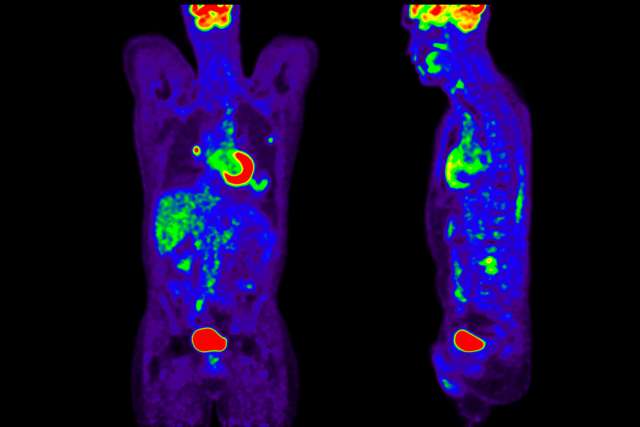 PET/CT scan for nuclear medicine