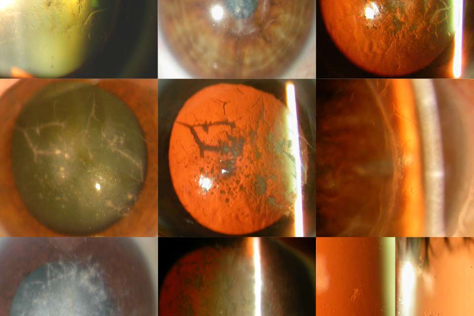 Close-up slit-lamp images of eyes showing various stages and patterns of cataract formation. 