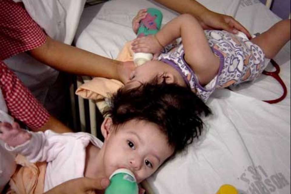 Twins before surgery