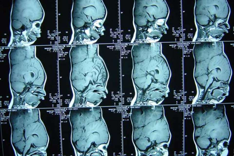 X-Ray image of conjoined sisters