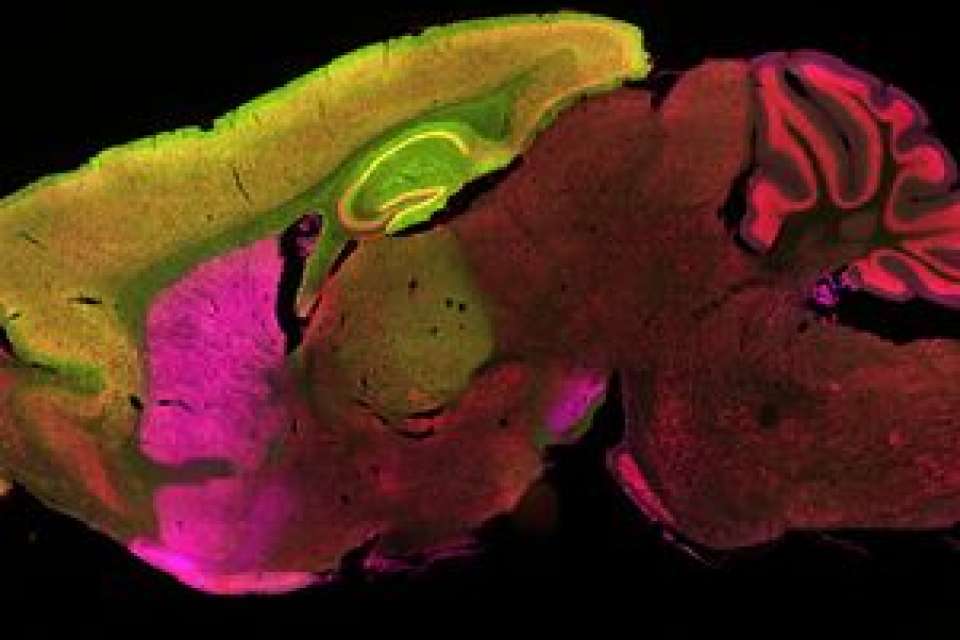 UCLA scientists hunt down origin of Huntington's disease in the brain ...