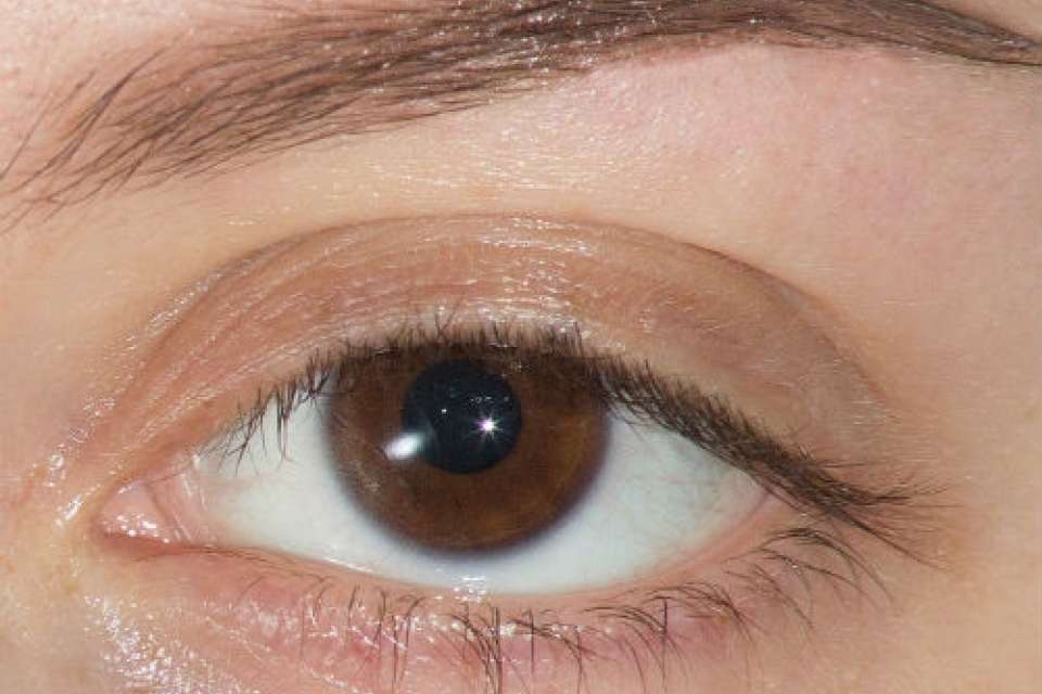 Got bedroom eyes? You may qualify for corrective surgery UCLA Health