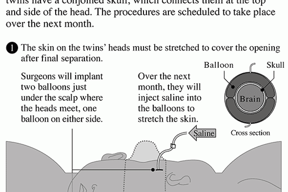 Illustration of procedure to separate the twin sisters