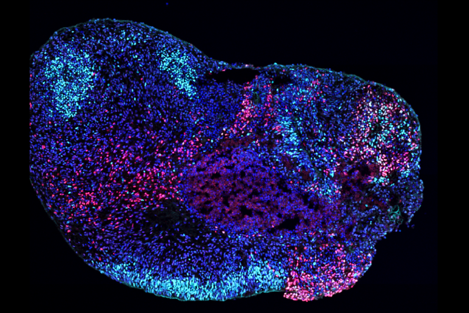 UCLA researchers find how epilepsy genes disrupt different brain ...