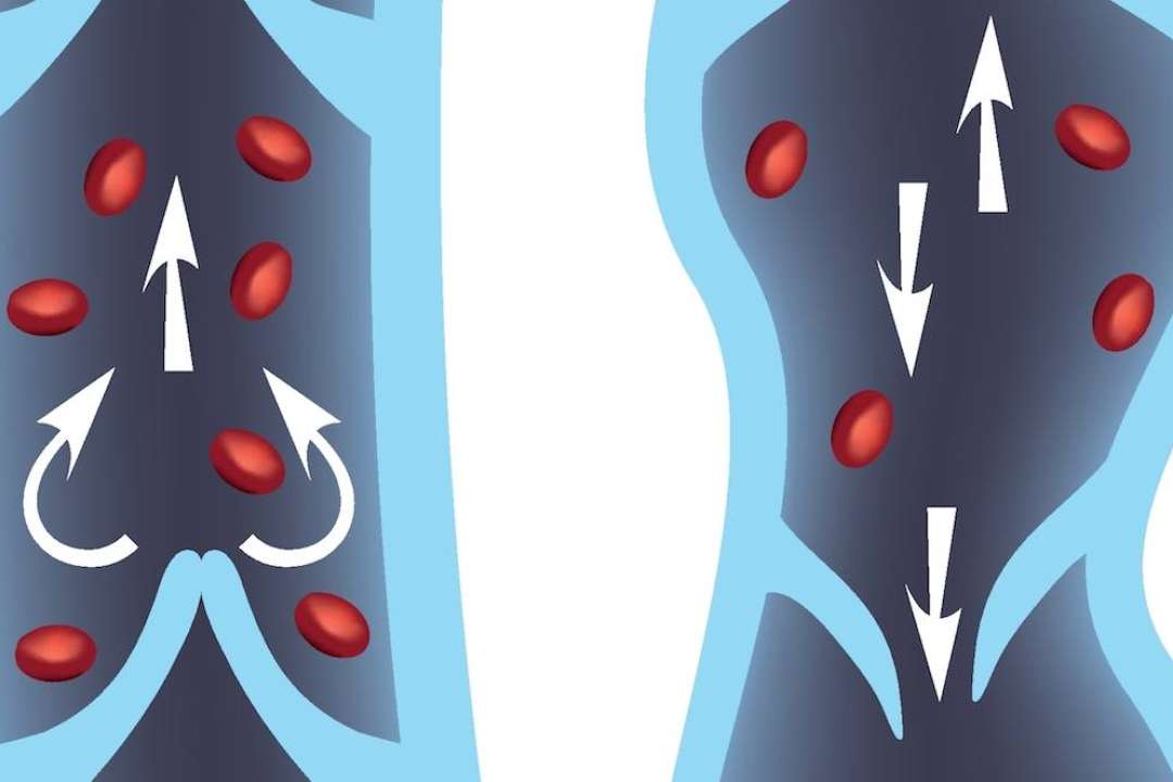 Blood clots that cause strokes can spawn smaller clots that may cause a