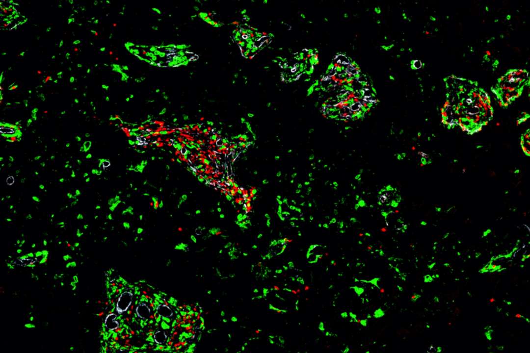 Study could help explain why certain brain tumors don’t respond well to ...