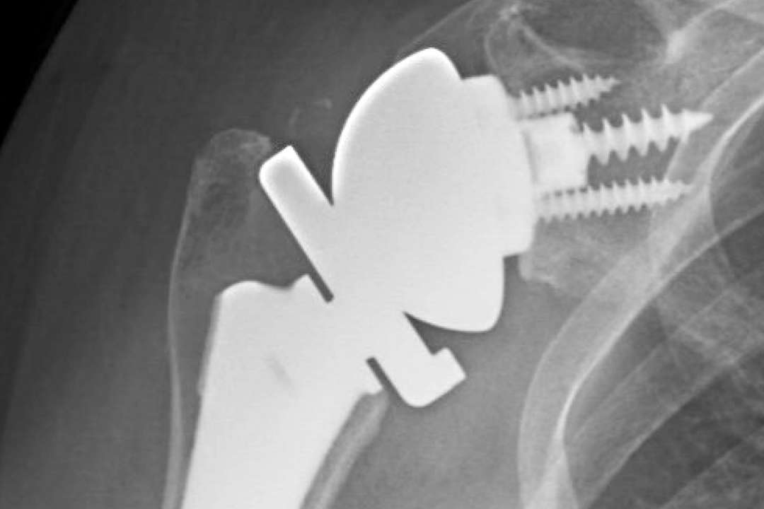 How common is shoulder replacement surgery? UCLA Health